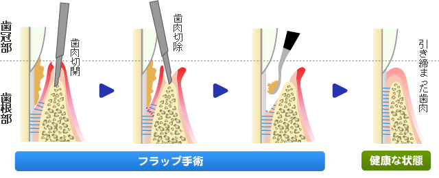 フラップ手術（歯肉剥離掻爬手術）