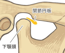 顎関節症：関節円板が前方に転移