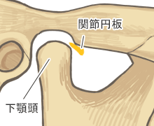 顎関節症：関節円板の前方転移がさらに大きい