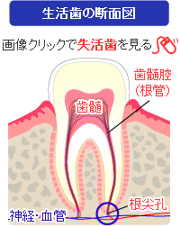 生活歯と失活歯の比較（断面図）