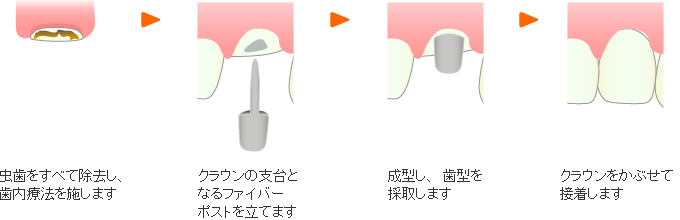 クラウン修復法の治療イメージ