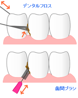 ＴＢＩ（歯磨き指導）