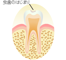 Ｃ０：初期虫歯の治療