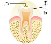 Ｃ１ ： エナメル質の虫歯