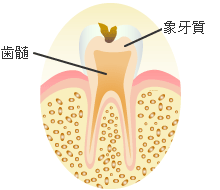 Ｃ２ ： 象牙質の虫歯