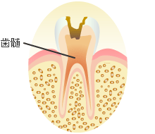 Ｃ３ ： 歯髄（歯の神経）の虫歯