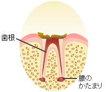 Ｃ４ ： 歯冠が崩壊した末期の虫歯