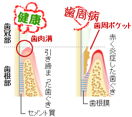 健康な歯ぐきと歯周病の歯ぐき