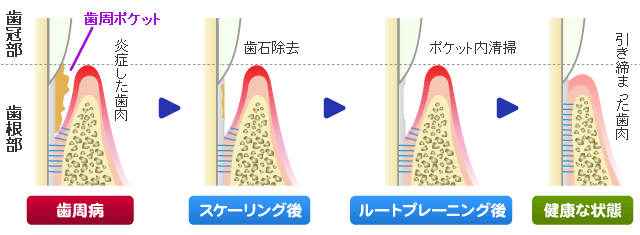 ルートプレーニング（歯根面クリーニング）