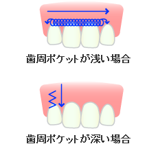 レーザーＳＲＰ（スケーリング・ルートプレーニング）