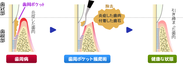 歯周ポケット掻爬(そうは)術