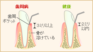 歯周ポケットの深度測定