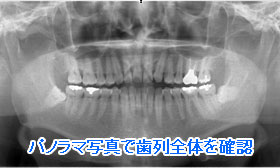 パノラマ写真で歯列全体を確認