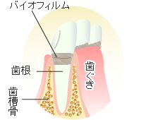 歯肉炎