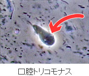 歯周病の原因となる代表的な原虫“口腔トリコモナス”