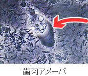 歯周病の原因となる代表的な原虫“歯肉アメーバ”