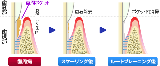 歯周内科治療３回目。スケーリング・ルートプレーニングで歯石除去。