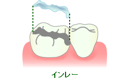 オールセラミックスインレー