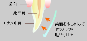 ラミネートベニア修復法