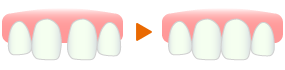 ラミネートによる“すきっ歯”の改善例