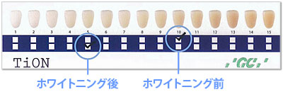 効果を楽しみながら安心ホワイトニング