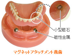 マグネットアタッチメント義歯
