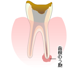 歯根のう胞摘出術