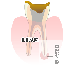 歯根端切除術