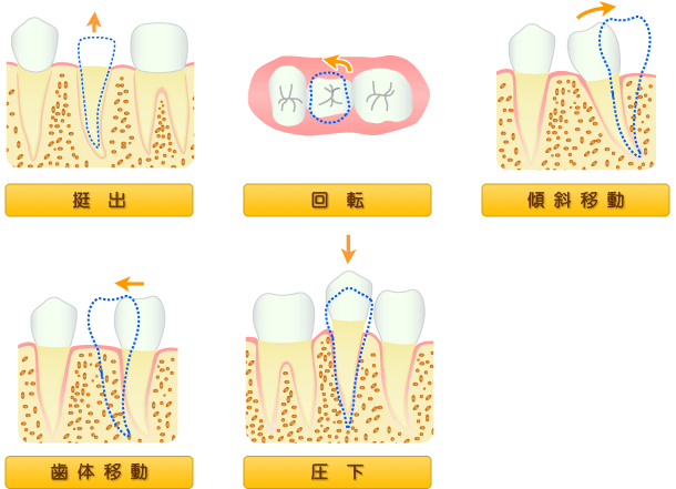 ＭＴＭ矯正