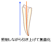 根管治療