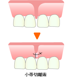 小帯切離術