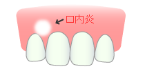 口内炎