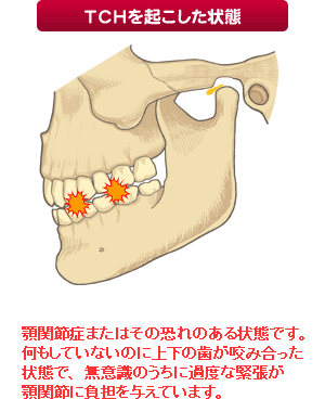 ＴＣＨを起こした状態