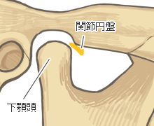 顎関節症：関節円板の前方転移がさらに大きい