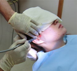 歯科レーザー治療